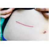 correção de cicatriz mamoplastia Mutinga