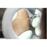 procedimento de shaving para lesão Mutinga