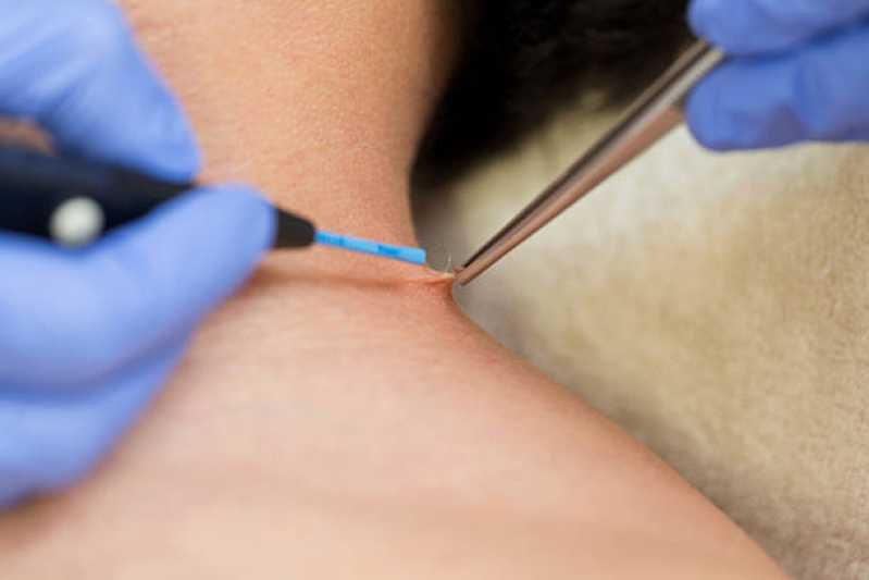 Tratamento de Crioterapia para Verruga Agendar Condomínio Refúgio Pinheiros - Tratamento de Crioterapia para Cicatriz