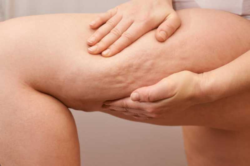 Tratamento para Celulite Grau 3 Clínica Zona Oeste - Tratamento para Celulite e Flacidez nas Pernas